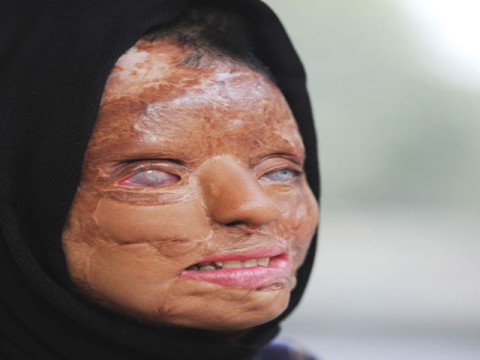 Acid attack victim who became a TV millionaire