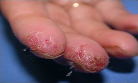 Dermatitis can fail fingerprint ID scan