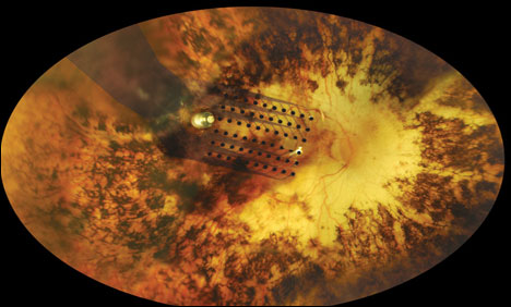 First retinal implant gets FDA approval