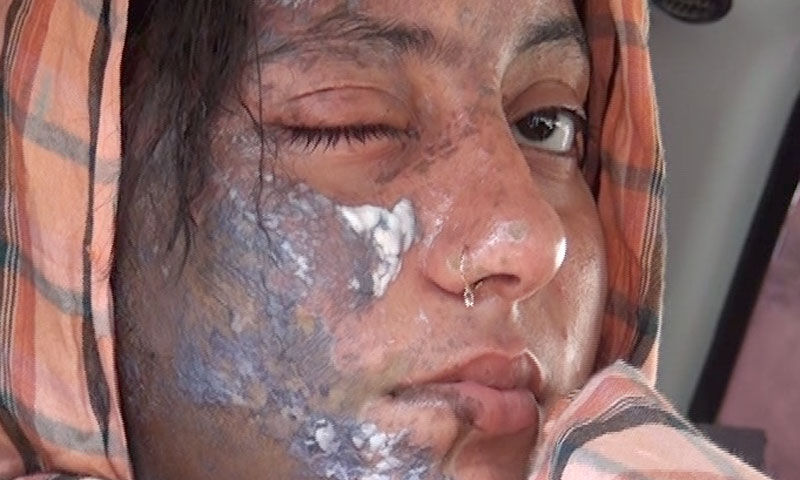 Acid attack on Pashto actress in Nowshera